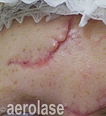 Aerolase Era Laser Before & After