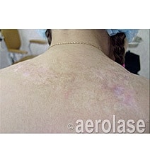 Aerolase Era Laser Before & After