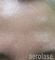 Aerolase Era Laser Before & After