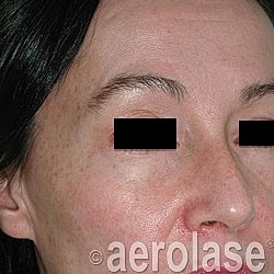 Aerolase Era Laser Before & After