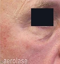 Aerolase Era Laser Before & After
