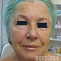 Aerolase Era Laser Before & After