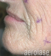 Aerolase Era Laser Before & After