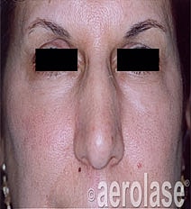 Aerolase Era Laser Before & After