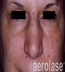 Aerolase Era Laser Before & After