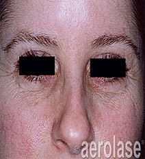 Aerolase Era Laser Before & After