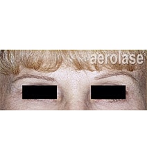 Aerolase Era Laser Before & After